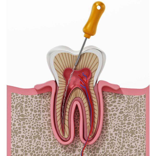 endodonzia